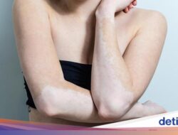 Hari Vitiligo Sedunia 2024, Kenali Sejarah dan Tema Peringatannya