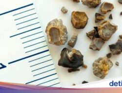 Bikin Penasaran, Ternyata Ini Alasan Batu Ginjal Bisa Berbentuk Seperti Jahe