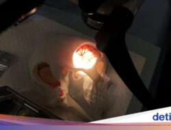 Bisa Mengancam Jiwa, Kenali Tanda-Tanda Pecah Pembuluh Darah Otak Di Bangun Tidur