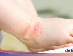 Eksim Anak Tak Sembuh-sembuh? Kata Ahli Kebugaran, Bisa Karena Itu Dipicu Minuman Ini