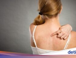 10 Penyebab Jerawat Di Punggung dan Cara Mudah Mengatasinya
