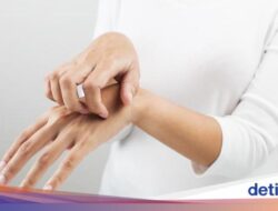Kenapa Bekas Herpes Zoster Masih Terasa Gatal? Begini Penjelasannya