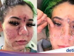 Viral Tiktoker Nekat Pakai Skincare Kedaluwarsa, Wajahnya Dari Sebab Itu Begini