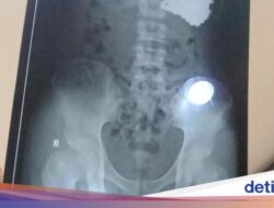 Ahli Kepuasan Bicara Kemungkinan Kepuasan Psikis Pria Nekat Telan 70 Alat Di Indramayu