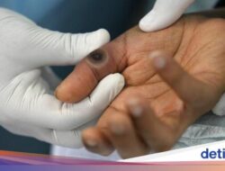 Afrika Selatan Laporkan Kematian Pertama Akibat Cacar Monyet ‘Mpox’