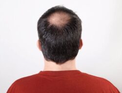 6 Penyebab Kebotakan Di Pria dan Cara Mengatasinya