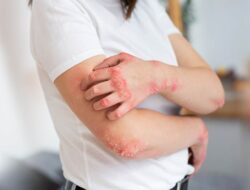 Kenali Ringworm, Penyakit Kulit yang Belakangan Viral Di Kalangan Anggota Gym