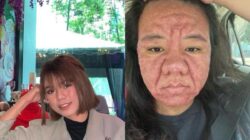 Viral Bumil Curhat Wajahnya Berubah Di Hamil, Insecure seperti Beda Orang