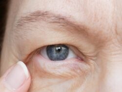 Mengenal Ptosis, Kebugaran Kelopak Mata yang Disindir Ahli Kebugaran Tompi