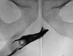 Ngilu! Momen Ahli Kebugaran Temukan Pinset ‘Nyangkut’ Hingga Mr P Di 4 Tahun