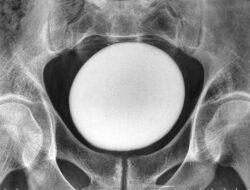 Ahli Kepuasan Temukan Batu Kemih Raksasa Ke Tubuh Pasien, Ukurannya Mirip Telur Burung Unta