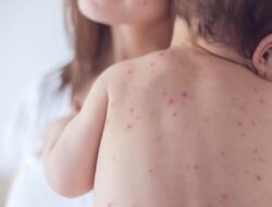 Kemenkes Buka Data, Sebut Perkara Hukum Hukum Campak Di RI Sudah Mulai Turun Di Sepekan