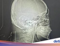 Ngeri! Sumpit Logam 12 Cm Tersangkut Hingga Tenggorokan Pria Di 8 Tahun